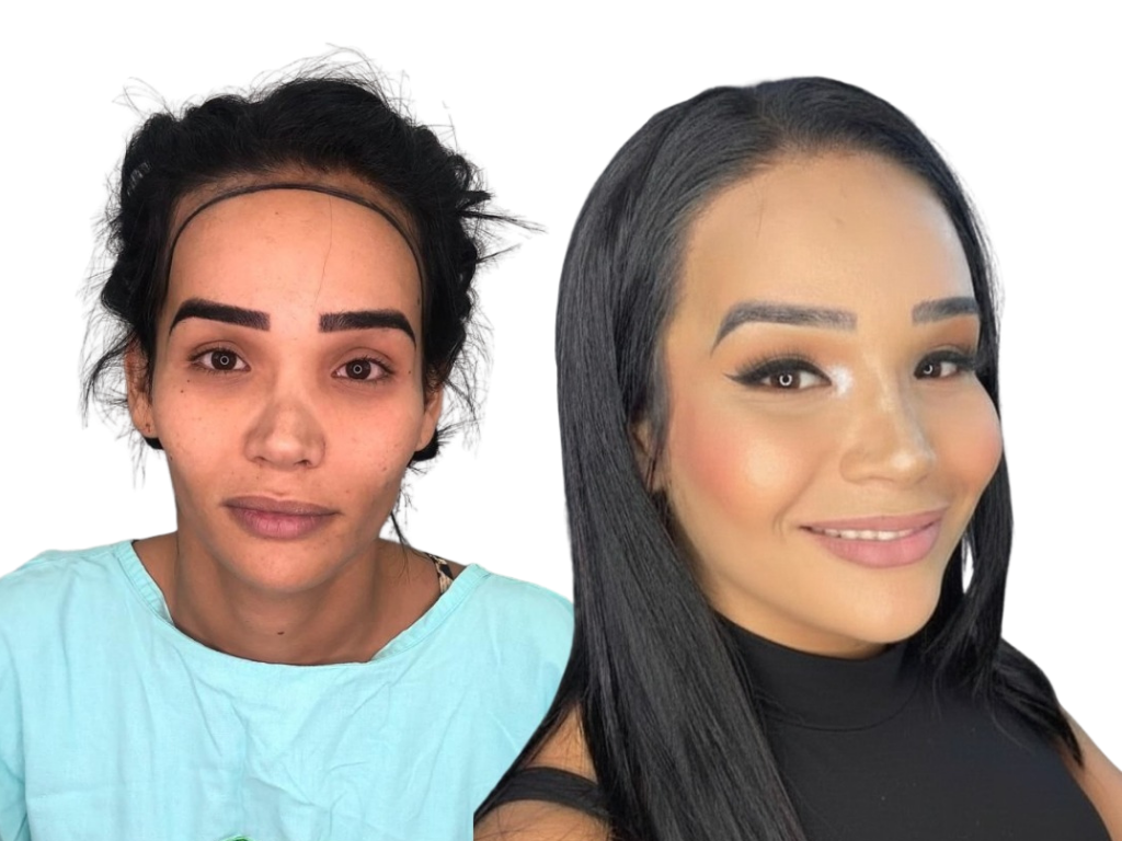 Antes e depois de Transplante Capilar Feminino na Yourmed