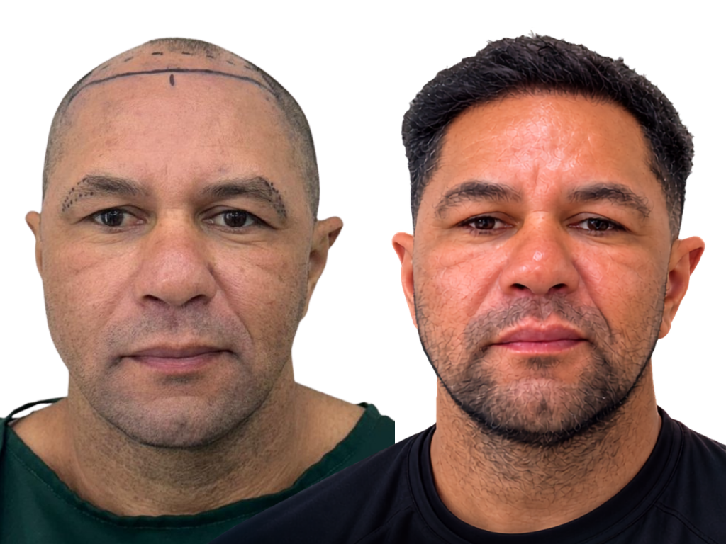 Antes e depois de Transplante Capilar na Yourmed