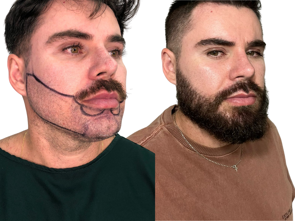 Antes e depois de Transplante de Barba na Yourmed