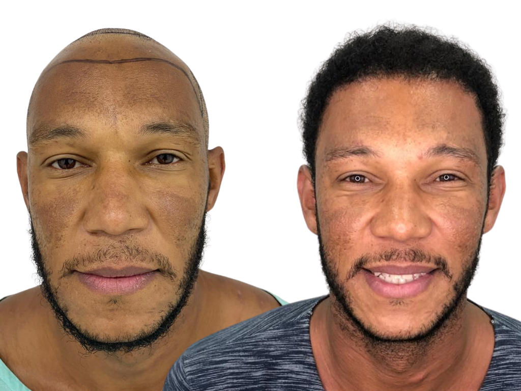 Antes e depois de Transplante Capilar na Yourmed