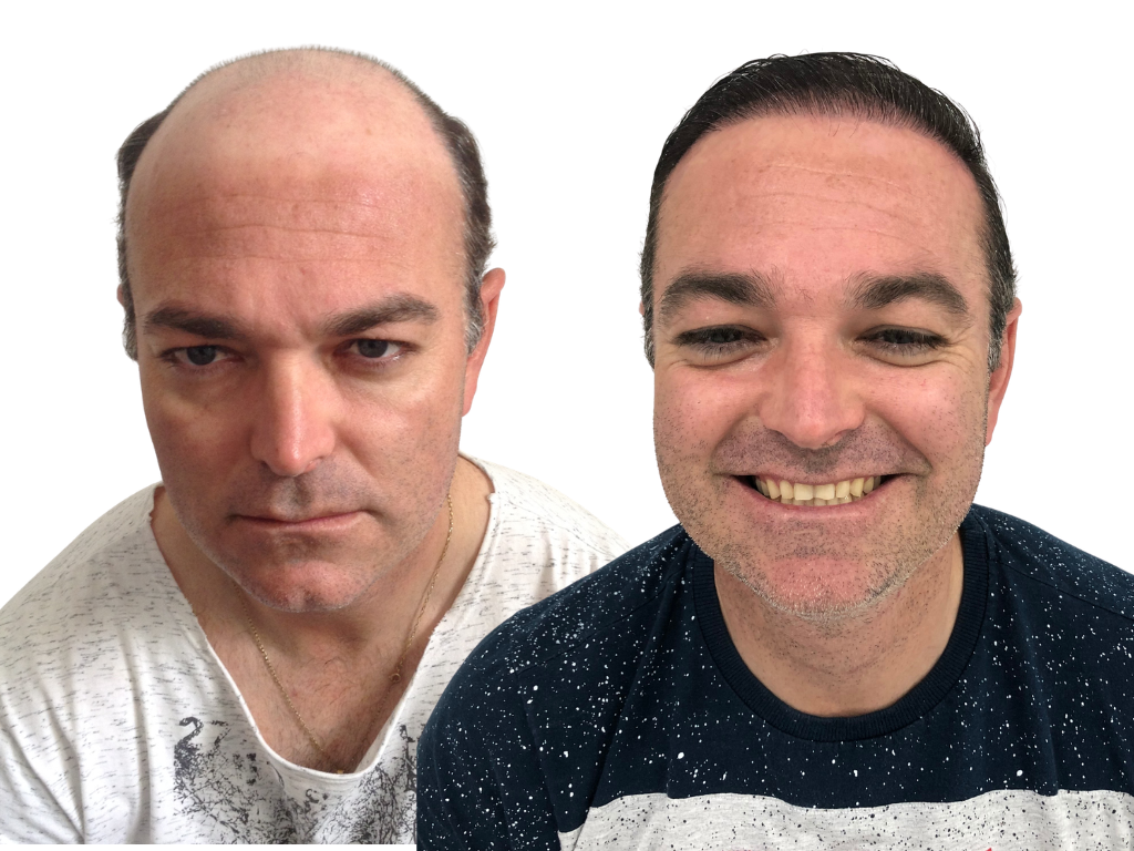 Antes e depois de Transplante Capilar na Yourmed