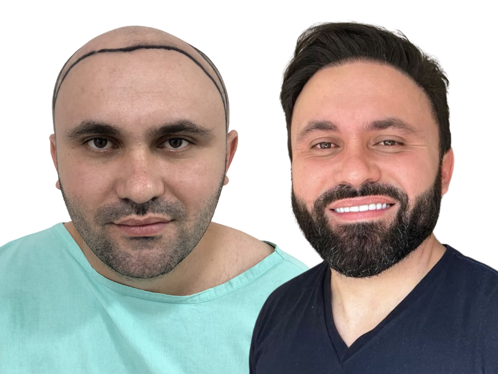 Antes e depois de Transplante Capilar na Yourmed