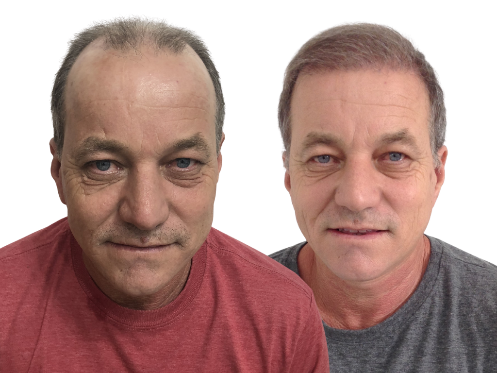 Antes e depois de Transplante Capilar na Yourmed